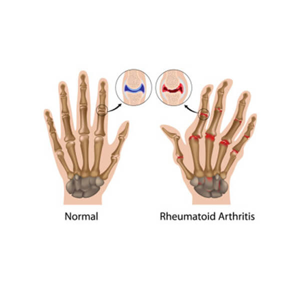 Schéma-de-l’arthrite