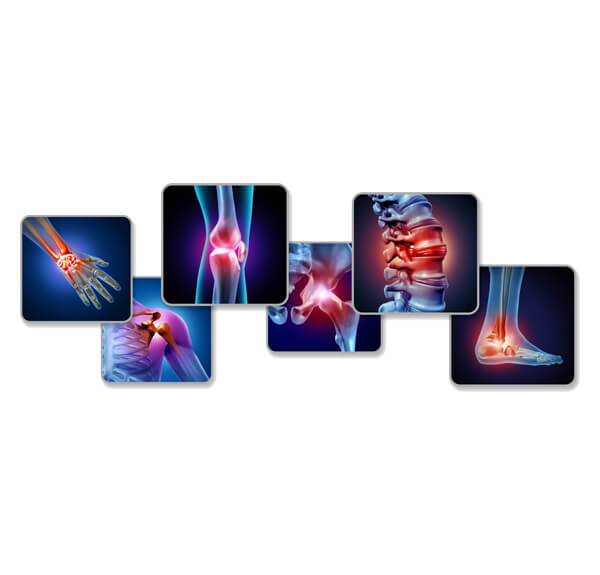 Schema-de-l’arthrite